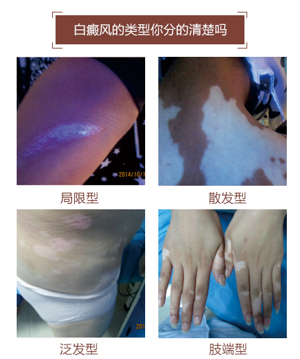 白癜风类型.jpg
